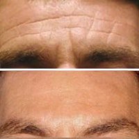 cosmetic injections forehead lines Hornsby Sydney