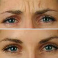 Hornsby Facial Aesthetics-cosmetic-injections-frown-lines-sydney