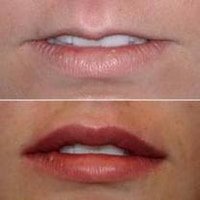 Hornsby Facial Aesthetics-lip-fillers-sydney