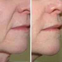Wahroonga Facial Aesthetics-naso-labial-lines