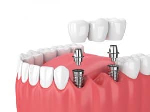 Dental Implant Solutions