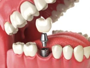 Dental-Implants 