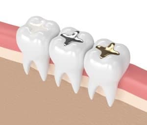 dental filling treatment