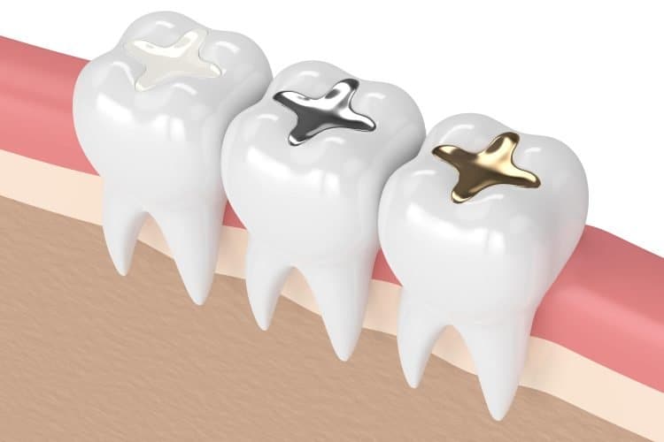 dental filling treatment
