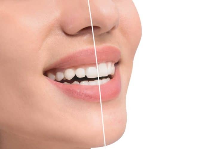 gum contouring (1)
