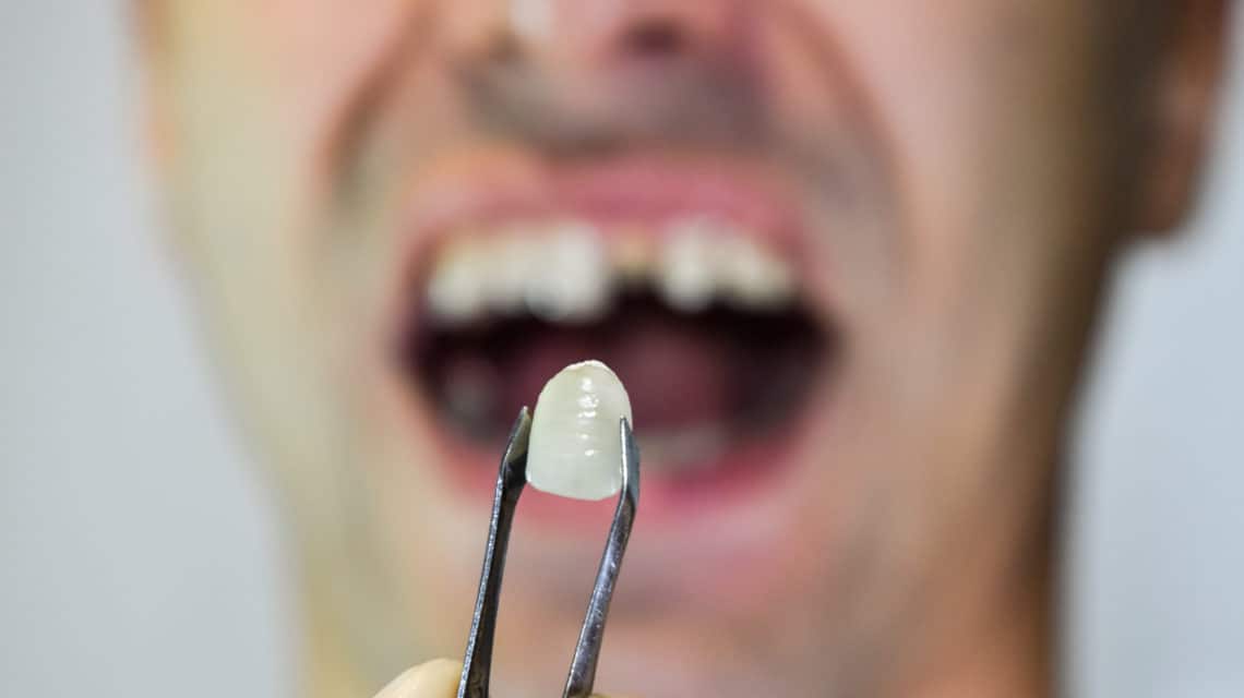 dental,prosthesis,of,metal,ceramics,in,tweezers.,a,patient,without