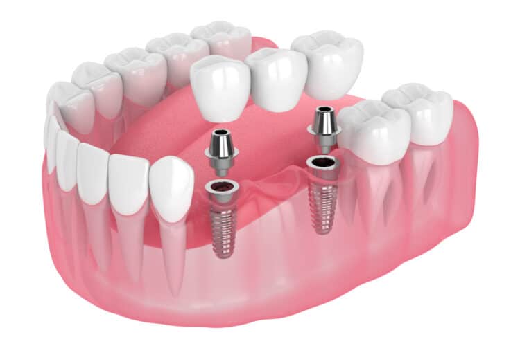What to Expect During Dental Implant Treatment
