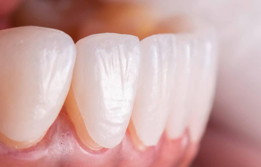 What Are Veneers: Information and Advice