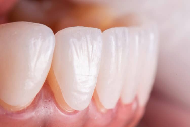 What Are Veneers: Information and Advice