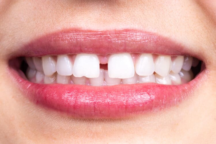 Everything About The Gap Between Teeth
