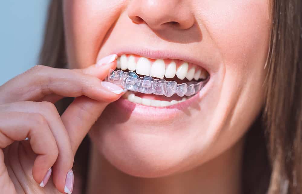 woman with perfect smile wearing invisible dental aligners for dental correction
